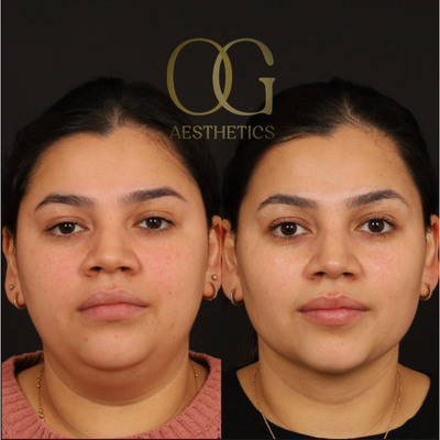 Chin Liposuction before and after photo