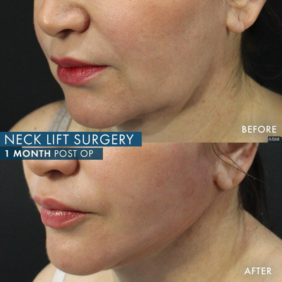 Neck Lift before and after photo