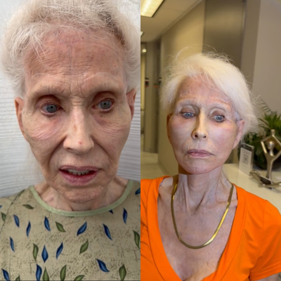 Facelift before and after photo