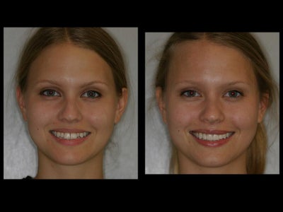 Smile Makeover before and after photo
