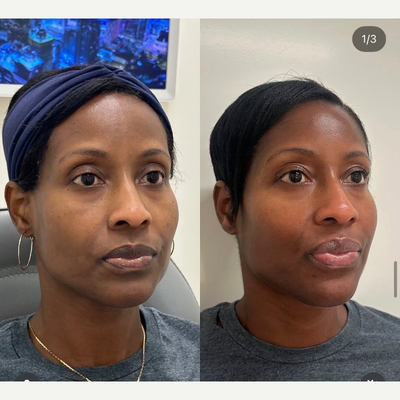Chemical Peel before and after photo