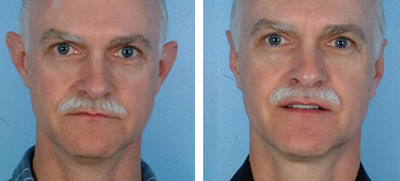 Ear Surgery before and after photo