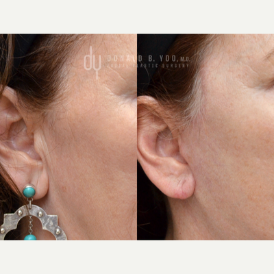 Revision Rhinoplasty before and after photo