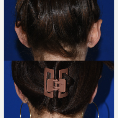 Ear Surgery before and after photo