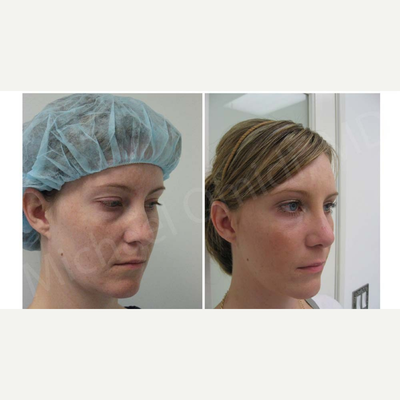 Eyelid Surgery before and after photo