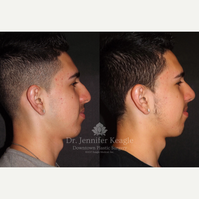 Rhinoplasty before and after photo