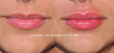 Lip Fillers before and after photo