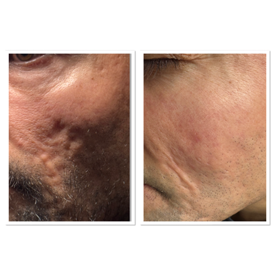Laser Scar Removal before and after photo