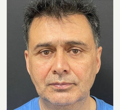 Facelift before and after photo