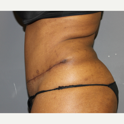 real self tummy tuck – Bad plastic surgery by Dr Shelby Brantley