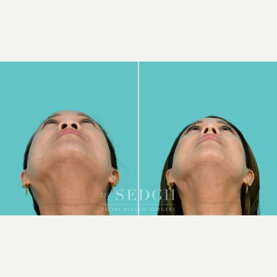 before and after image