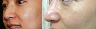 IPL before and after photo