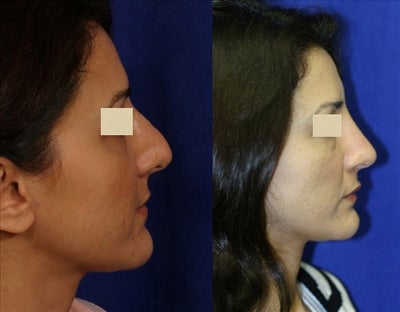 Revision Rhinoplasty before and after photo