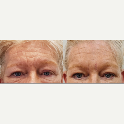 Dermal Fillers before and after photo