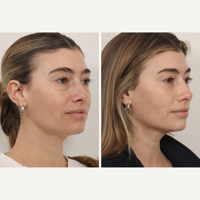 Facial Fat Transfer before and after photo