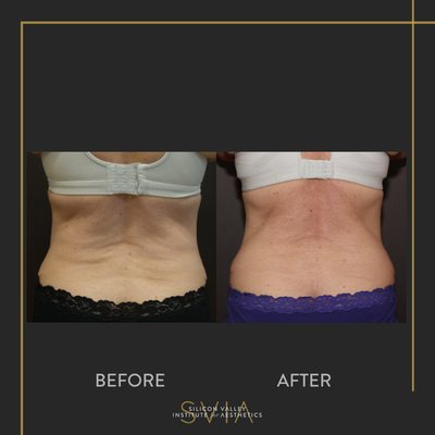 CoolSculpting before and after photo