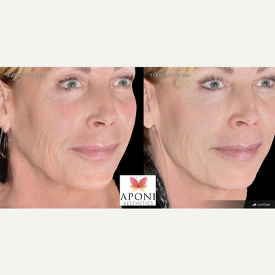 Skin Tightening before and after photo