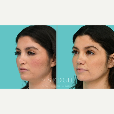 Revision Rhinoplasty before and after photo