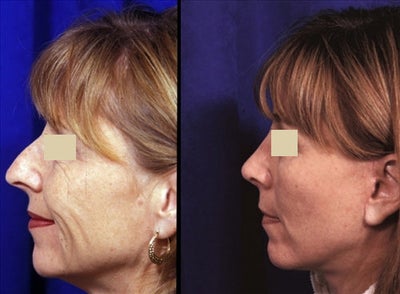Rhinoplasty before and after photo