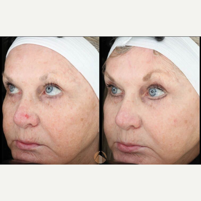 Photodynamic Therapy before and after photo