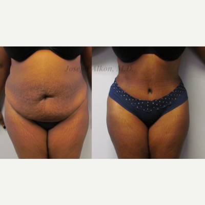 Tummy Tuck before and after photo