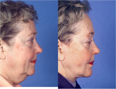 Neck Lift before and after photo
