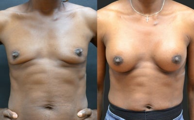 Breast Augmentation before and after photo