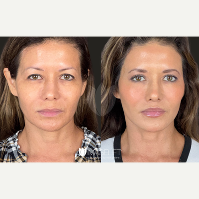 Dermal Fillers before and after photo
