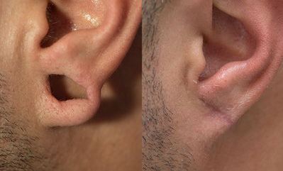 Earlobe Repair before and after photo
