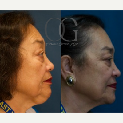 Lipoma Removal before and after photo
