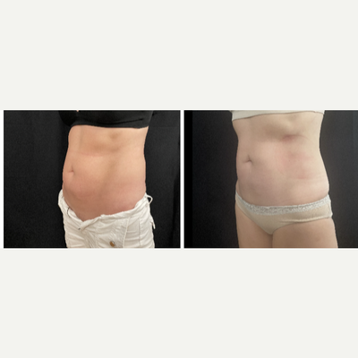 Emsculpt before and after photo