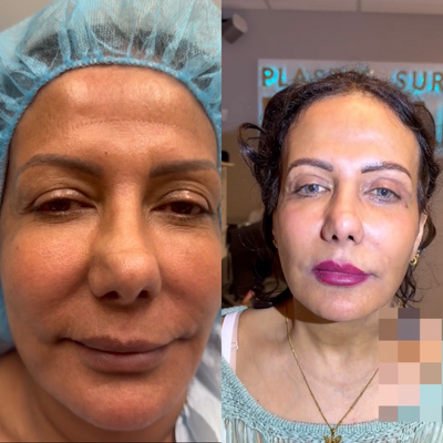 Eyelid Surgery before and after photo