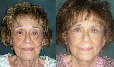 Facelift before and after photo