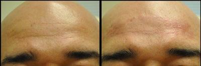Belotero before and after photo