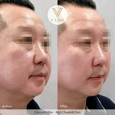 Chin Filler before and after photo