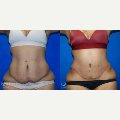 Liposuction before and after photo