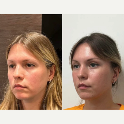 Brow Lift before and after photo