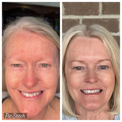 Chemical Peel before and after photo