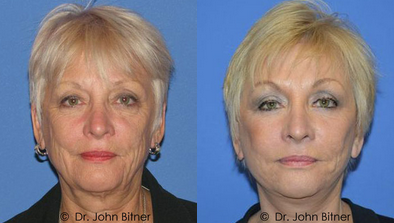 Brow Lift before and after photo
