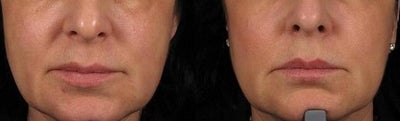 Collagen Injection before and after photo