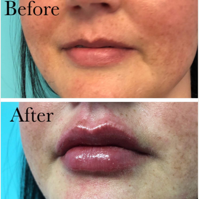 Dermal Fillers before and after photo
