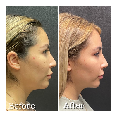 Chin Implant before and after photo