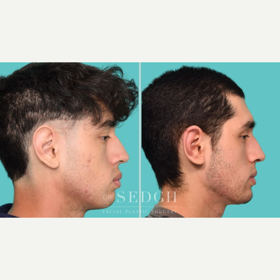 Ear Surgery before and after photo