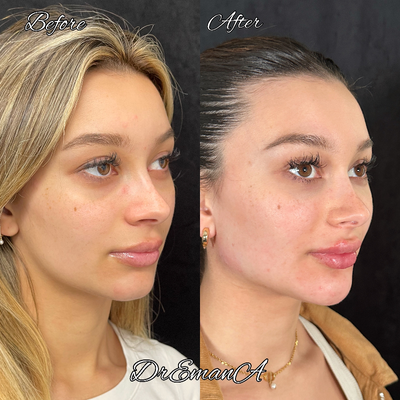 Lip Fillers before and after photo