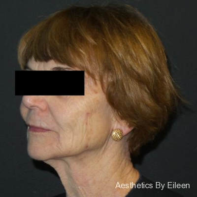 Aesthetics By Eileen Laser Skin Care Medical Spa Raleigh Raleigh North Carolina Realself