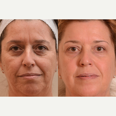Laser Resurfacing before and after photo