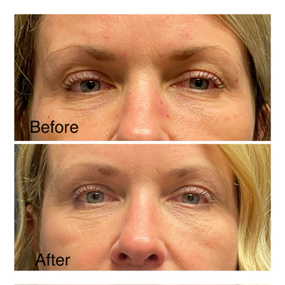 Brow Lift before and after photo
