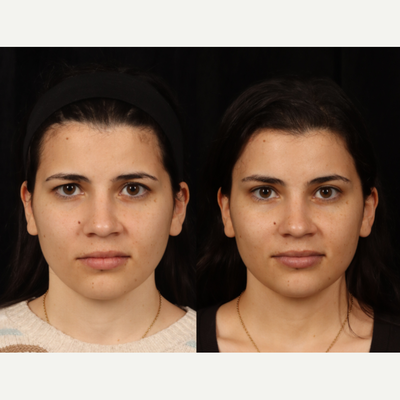 Brow Lift before and after photo