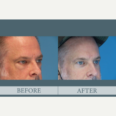 Eyelid Surgery before and after photo