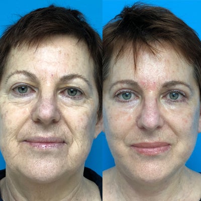 Deep Plane Facelift before and after photo